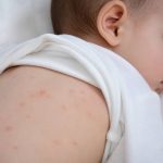 Piqures punaises de lit bebe : reconnaître les signes et protéger son enfant