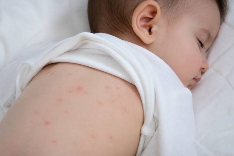 Piqures punaises de lit bebe : reconnaître les signes et protéger son enfant