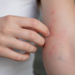 Piqures punaises de lit ou moustiques : comment les reconnaître et les différencier