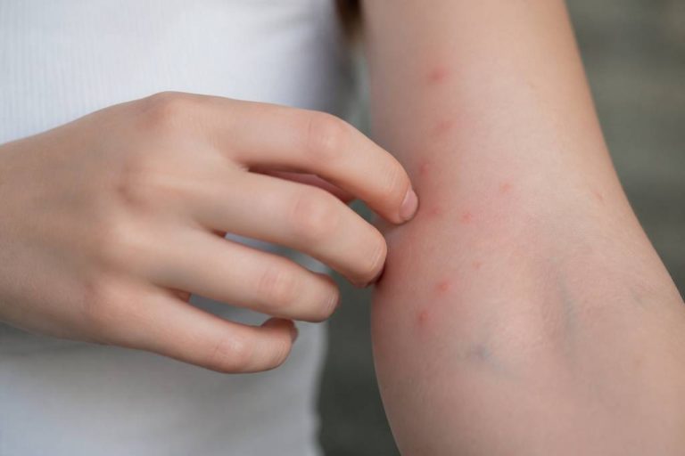 Piqures punaises de lit ou moustiques : comment les reconnaître et les différencier