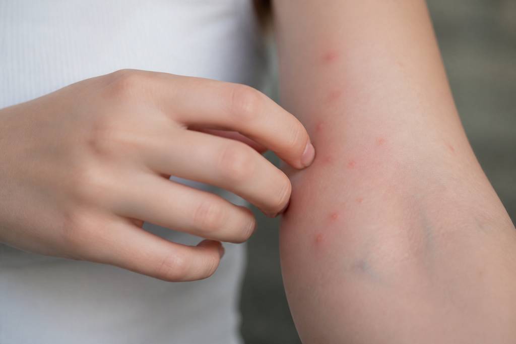 Piqures punaises de lit ou moustiques : comment les reconnaître et les différencier