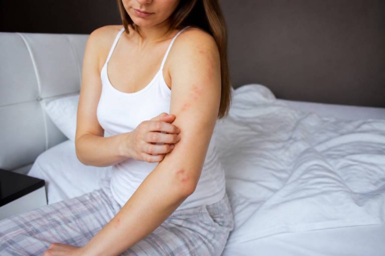 Allergies punaises de lit : symptômes, causes et solutions efficaces