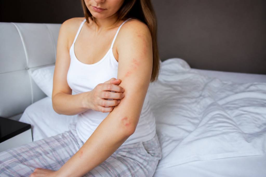 Allergies punaises de lit : symptômes, causes et solutions efficaces