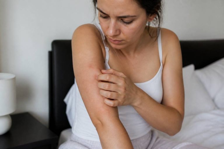 Allergie punaises de lit : symptômes, causes et solutions efficaces