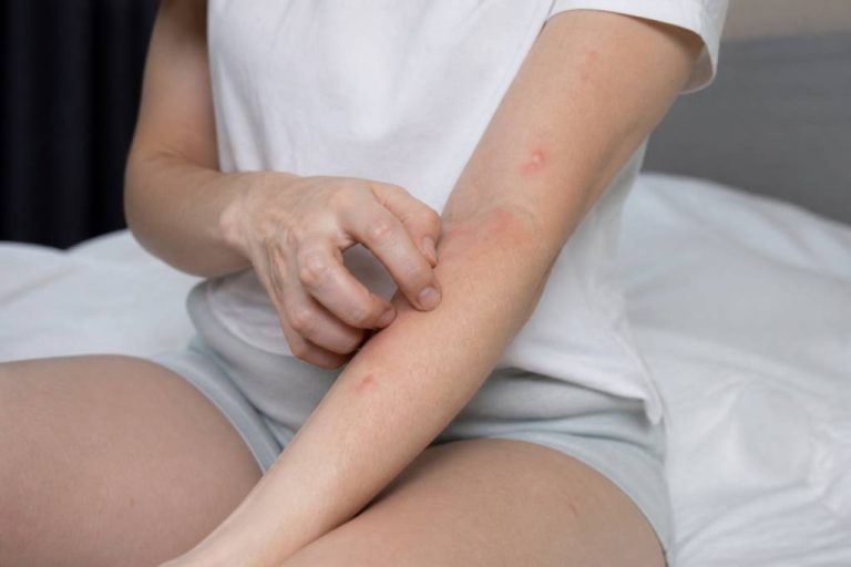 Allergie aux punaises de lit : symptômes, causes et solutions efficaces