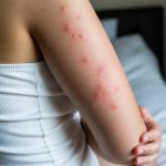Allergie aux piqures de punaises de lit : symptômes, causes et solutions