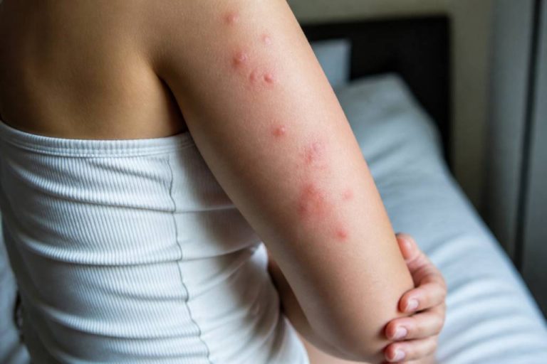 Allergie aux piqures de punaises de lit : symptômes, causes et solutions